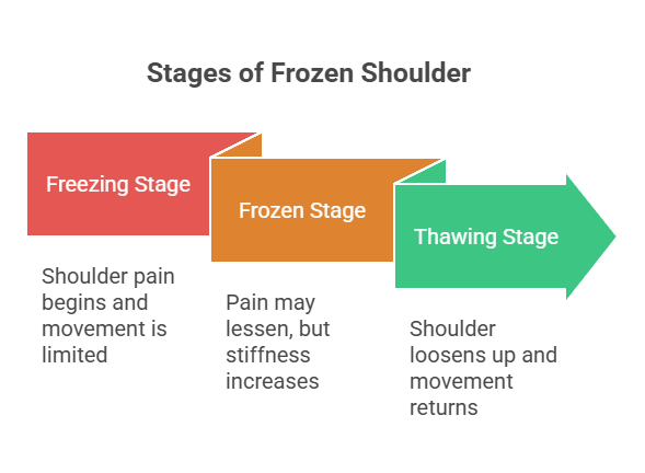 Physical Therapy for Frozen Shoulder - visual selection